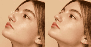 tipos de rinoplastia