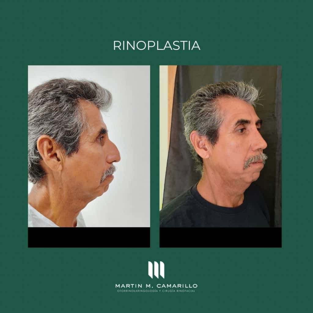 Antes y despues - Dr. Martin